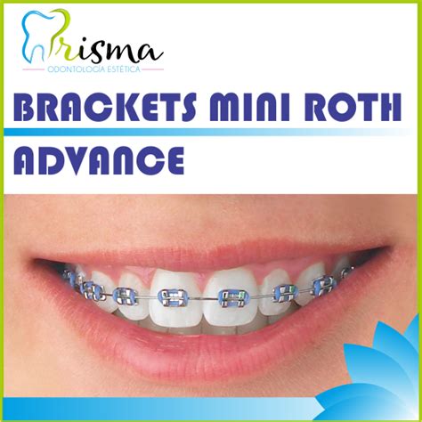 brackets mini roth metalicos|mini master brackets.